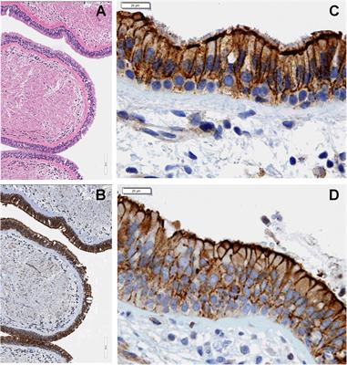 TGF-β1 Augments the Apical Membrane Abundance of Lemur Tyrosine Kinase 2 to Inhibit CFTR-Mediated Chloride Transport in Human Bronchial Epithelia